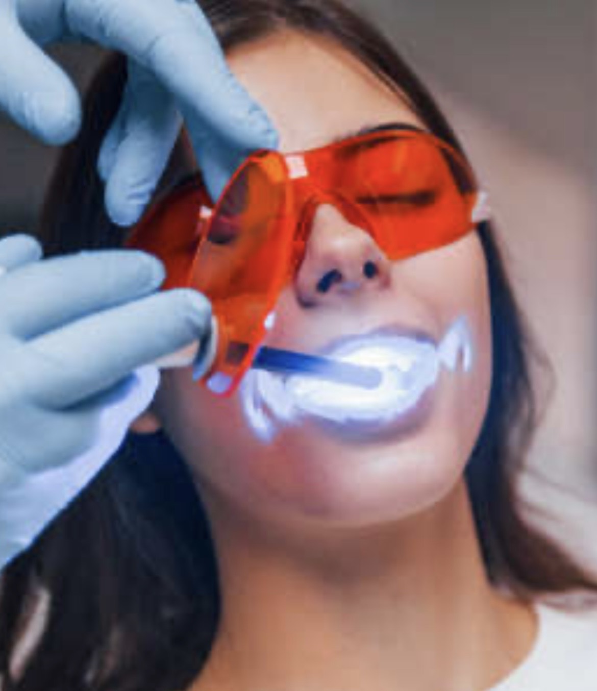 Professional Teeth Whitening