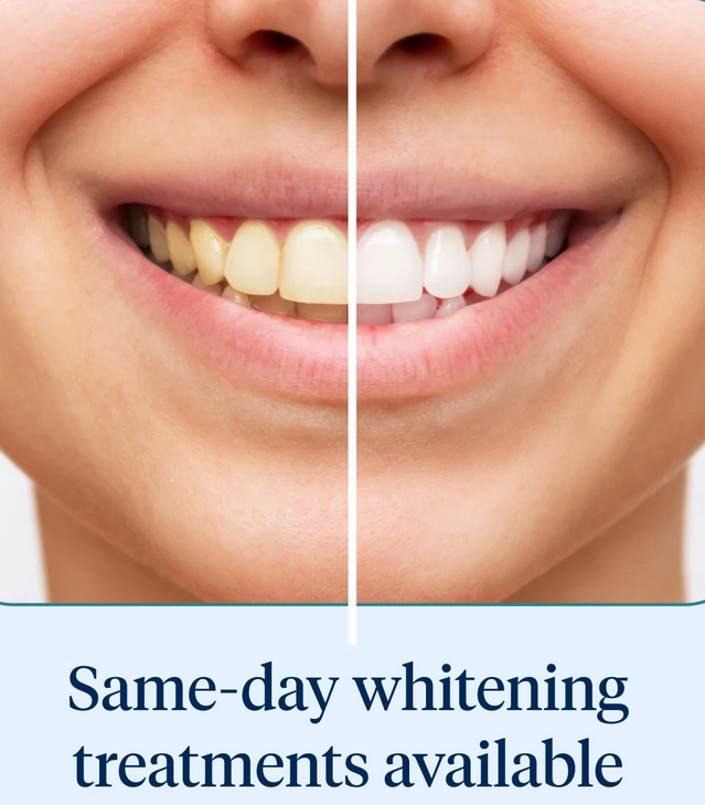 Professional Teeth Whitening