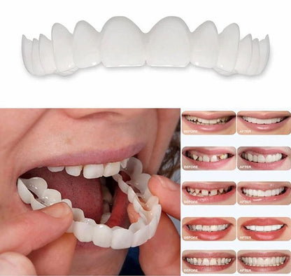 Snap On Veneers TOP Arch Only. (3D Printed with Hybrid nanoceramic)