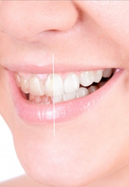 Professional Teeth Whitening. (Professional in-office) with *ZOOM* Light