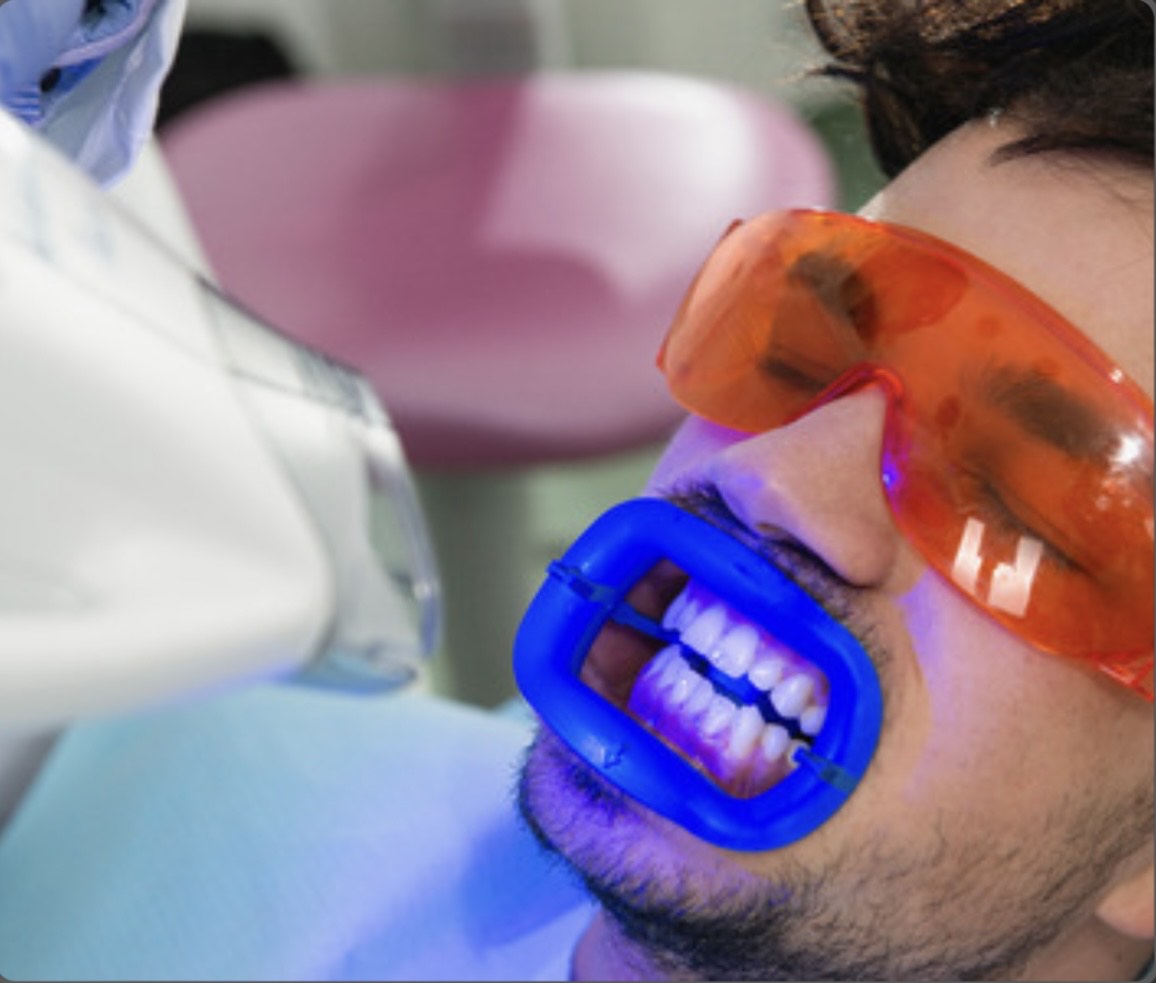 Professional Teeth Whitening