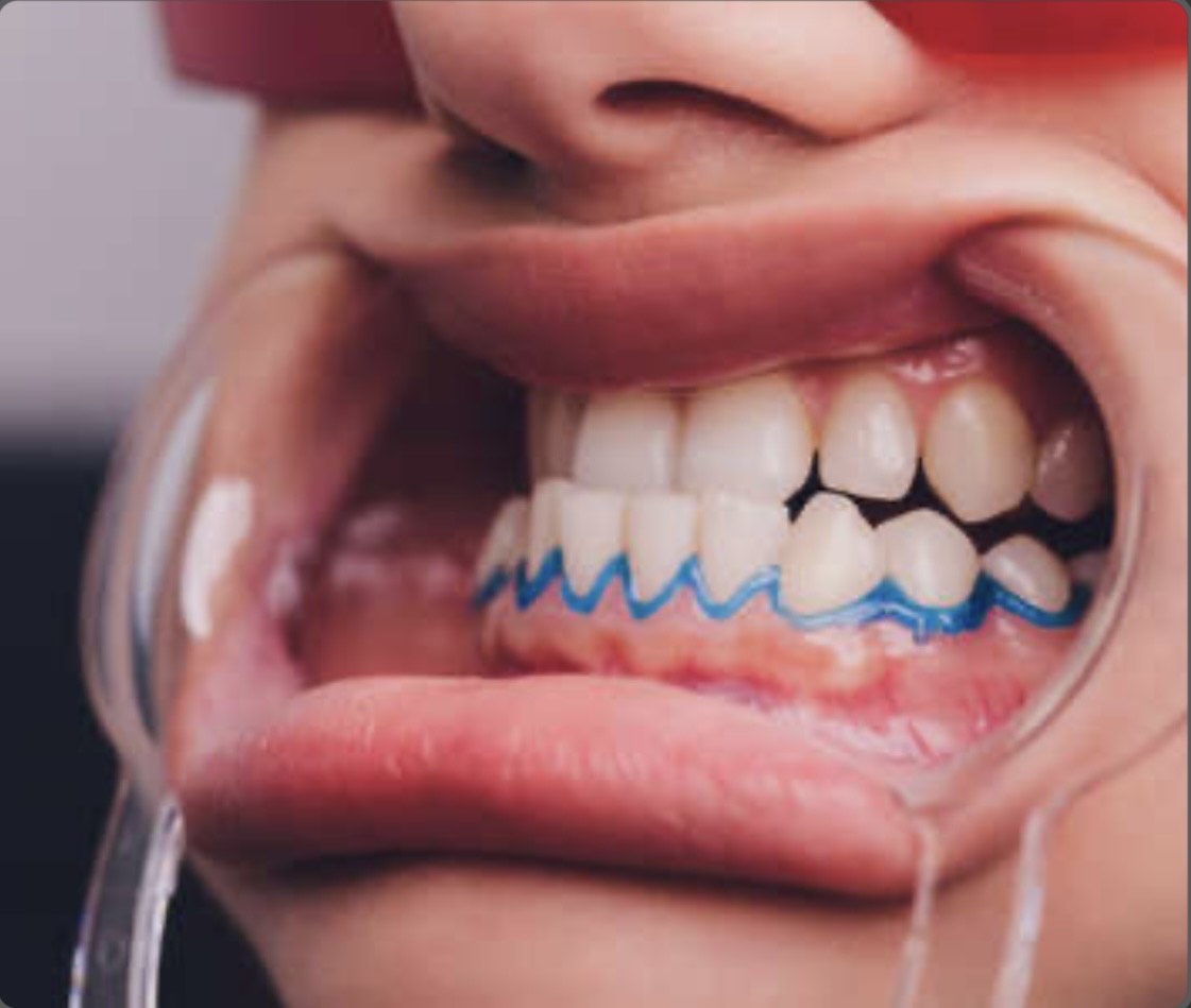 Professional Teeth Whitening