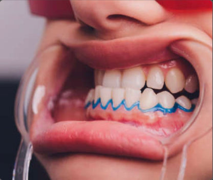 Professional Teeth Whitening. (Professional in-office) with *ZOOM* Light