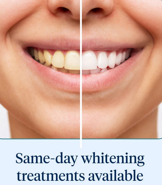 Custom Bleaching Trays/ Professional Grade Tooth Whitening Gel. Convenient At-Home Solution