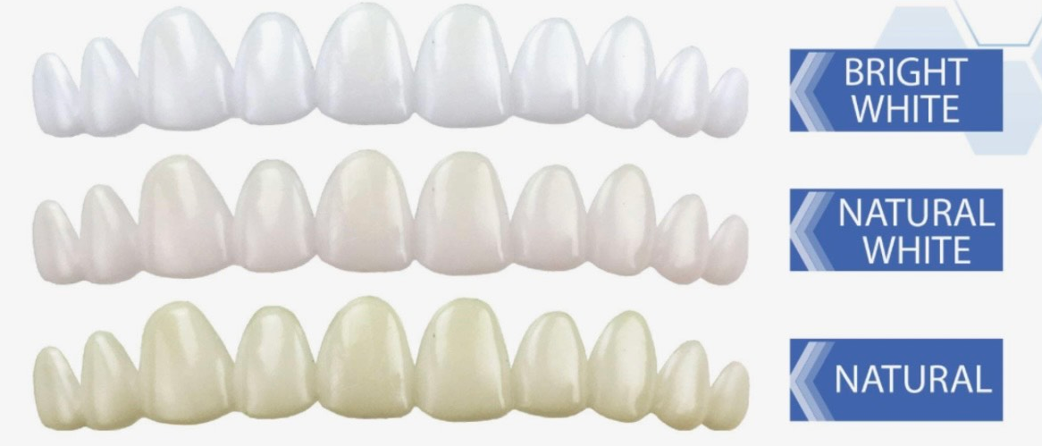 Snap On Veneers TOP Arch Only. (3D Printed with Hybrid nanoceramic)