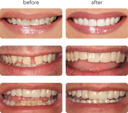 Snap On Veneers TOP Arch Only. (3D Printed with Hybrid nanoceramic)